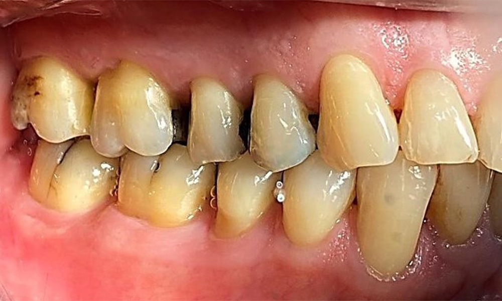 Right lateral view. Loss of the interdental papillae. Right lateral view. Loss of the interdental papillae.