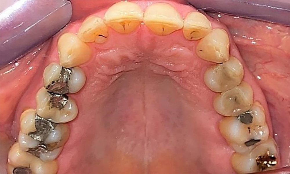 Occlusal view of the maxilla. Insufficient amalgam filling of 14 with a marginal gap. Occlusal view of the maxilla. Insufficient amalgam filling of 14 with a marginal gap.