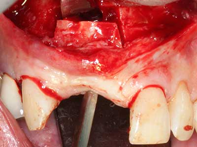 Piezosurgery Piezosurgery