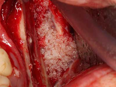 Piezosurgery Piezosurgery