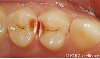 Fig. 3: On initial opening, the caries is clearly clinically visible. Fig. 3: On initial opening, the caries is clearly clinically visible.