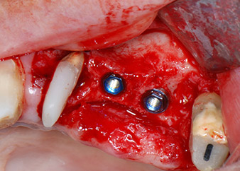 ready for the cover screws ready for the cover screws