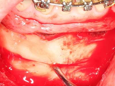 Piezosurgery Piezosurgery