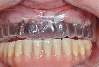 Plastic template Plastic template