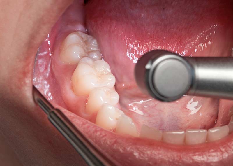 Synea Vision / Fusion Synea Vision / Fusion