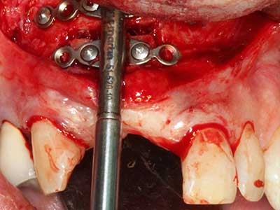 Piezosurgery Piezosurgery