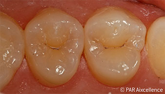 Fig. 1: Initial image of teeth without clinical caries apparent. Fig. 1: Initial image of teeth without clinical caries apparent.