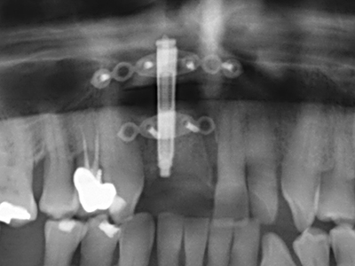 Piezosurgery Piezosurgery