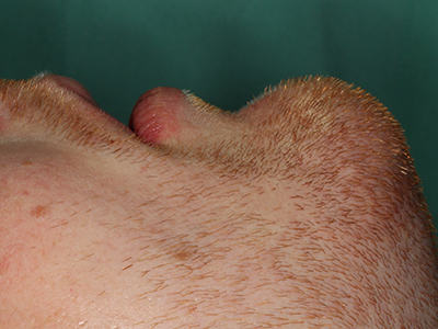 Piezosurgery Piezosurgery