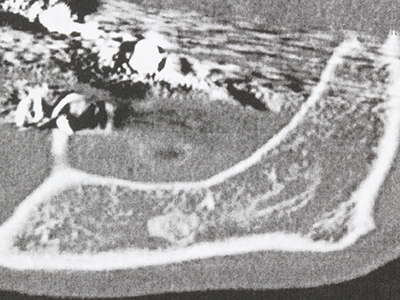 Piezosurgery Piezosurgery