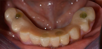 Implantes Implantes