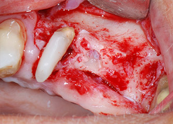 osseous defects osseous defects