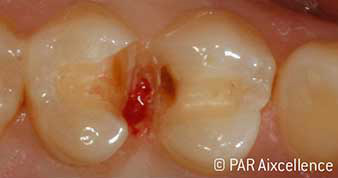 Fig. 5: After further excavation, clinically clearly visible caries, approximal fissure appears to be free of caries. Fig. 5: After further excavation, clinically clearly visible caries, approximal fissure appears to be free of caries.