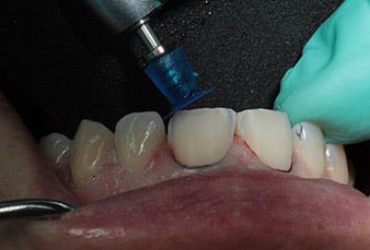 Polishing of the preparation prior scanning Polishing of the preparation prior scanning