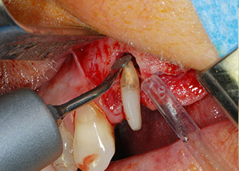 apice buccale del dente 24 apice buccale del dente 24