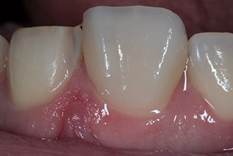 Einprobe des Veneers vor der Zementierung Einprobe des Veneers vor der Zementierung