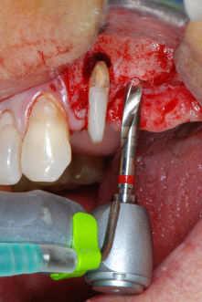 Implantatmotor Implantatmotor