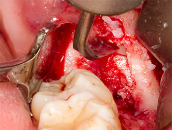 Piezomed B5 Piezomed B5