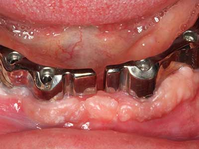 Piezosurgery Piezosurgery