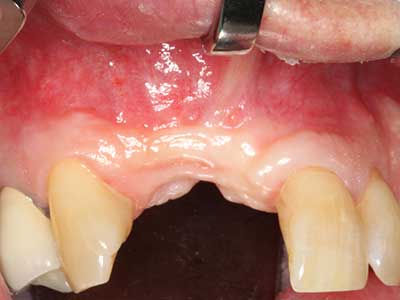 Piezosurgery Piezosurgery