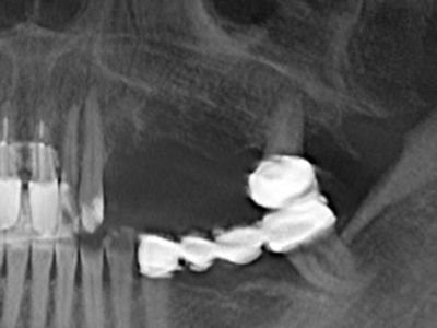 Piezosurgery Piezosurgery