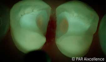 Fig. 8: Image as in Figure 7 - this time using Facelight: Caries no longer exists. Fig. 8: Image as in Figure 7 - this time using Facelight: Caries no longer exists.