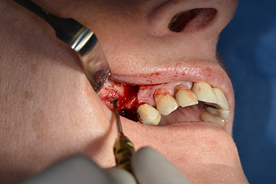 Implantation Implantation