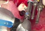 Sinusbodenelevation, Knochenaugmentation