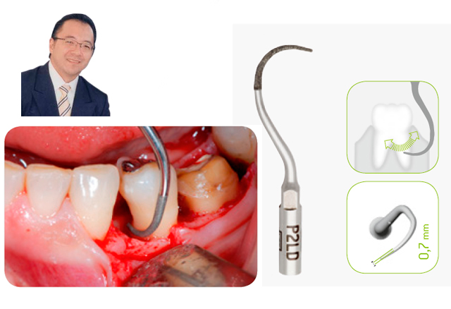 Offenes parodontales Debridement von Dr. Kenji Hosoya