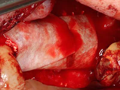 Piezosurgery Piezosurgery