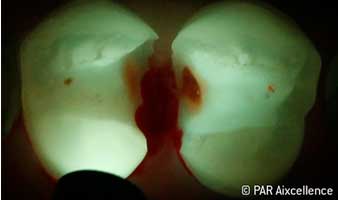 Fig. 6: Image as in Figure 5 - this time using Facelight: Caries now also clearly identifiable in the fissures. Fig. 6: Image as in Figure 5 - this time using Facelight: Caries now also clearly identifiable in the fissures.