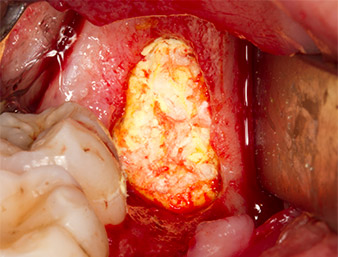 collagen fleece  collagen fleece