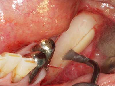 Piezosurgery Piezosurgery