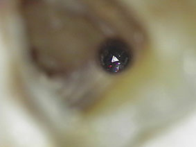 Abb. 3 u. 4: Zustand nach Revision des Wurzelkanals und Darstellung des frakturierten Instruments. Abb. 3 u. 4: Zustand nach Revision des Wurzelkanals und Darstellung des frakturierten Instruments.