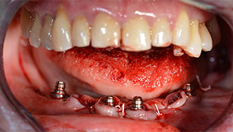 Implants Implants