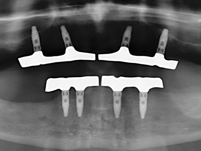 Piezosurgery Piezosurgery