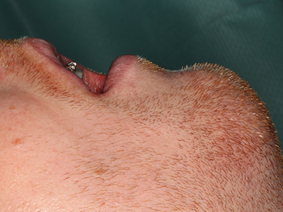 Piezo surgery Piezo surgery