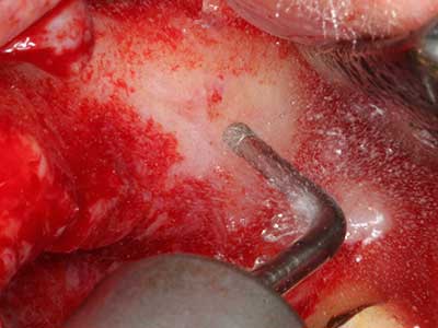 Piezosurgery Piezosurgery