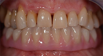 Osseointegration  Osseointegration