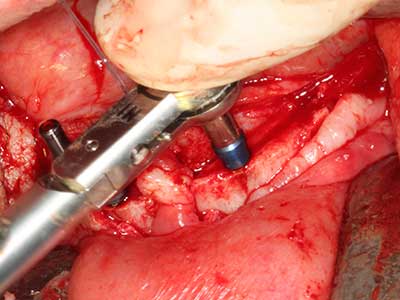 Piezo surgery Piezo surgery