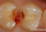 Facelight part 2 - The safe method of caries detection