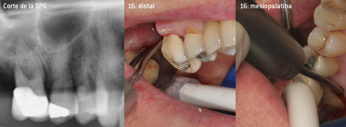 Desbridamiento cerrado de la furcación de la pieza 16  Desbridamiento cerrado de la furcación de la pieza 16