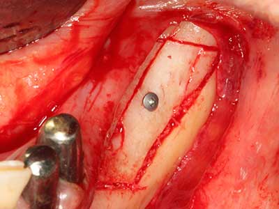 Piezo surgery Piezo surgery