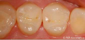 Fig. 9: Completed, long-lasting restorations. Fig. 9: Completed, long-lasting restorations.