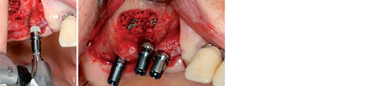 Insertion of three implants in the upper jaw Insertion of three implants in the upper jaw