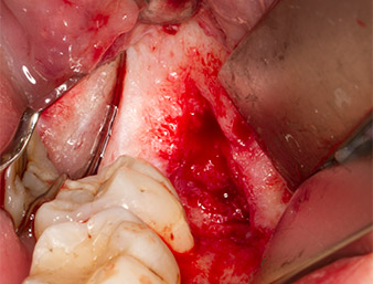 Granulation tissue  Granulation tissue