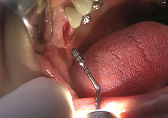 Preparation of maxillary sinus floor and lifting of Schneiderian membrane (Z35P instrument) Preparation of maxillary sinus floor and lifting of Schneiderian membrane (Z35P instrument)