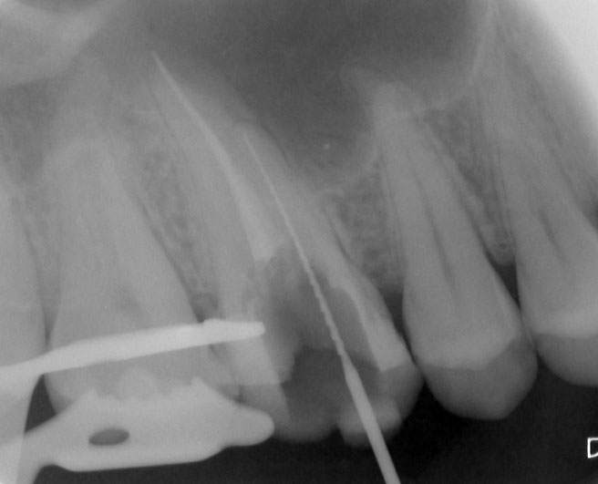 Abb. 3 u. 4: Zustand nach Revision des Wurzelkanals und Darstellung des frakturierten Instruments. Abb. 3 u. 4: Zustand nach Revision des Wurzelkanals und Darstellung des frakturierten Instruments.