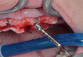 Implant motor (Implantmed) Implant motor (Implantmed)