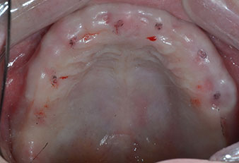Implantatpositionen Implantatpositionen